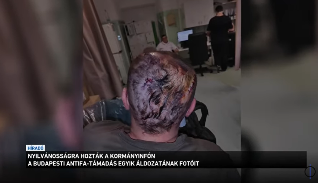 Nyilvánosságra hozták a kormányinfón a budapesti antifa támadás egyik áldozatának fotóit