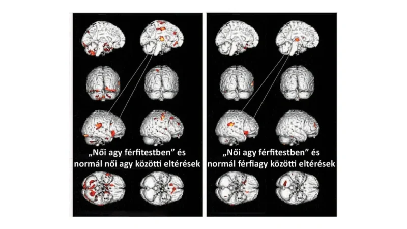 Itt a tudományos bizonyíték: a transzneműség pszichés betegség, nem biológiai adottság