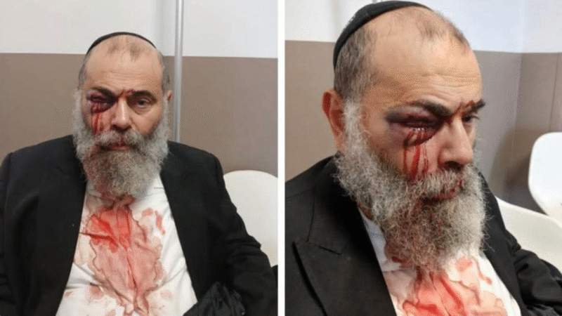 „Meg fogunk ölni, te mocskos zsidó” – egy hatvanéves, kipát viselő férfit hátulról brutálisan megtámadtak Franciaországban